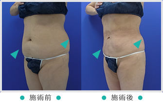 上下側腹部ウエスト
