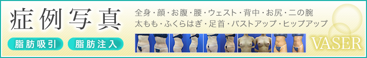 ベイザー脂肪吸引の症例写真