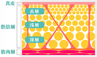 従来の脂肪吸引