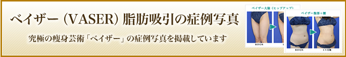 ベイザー脂肪吸引の症例写真