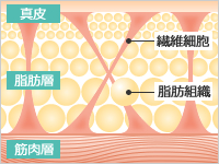 麻酔液を皮下脂肪に満たします