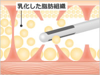 刃のないカニューレで脂肪だけを根こそぎ除去します