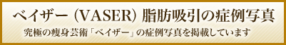 ベイザー脂肪吸引の症例写真