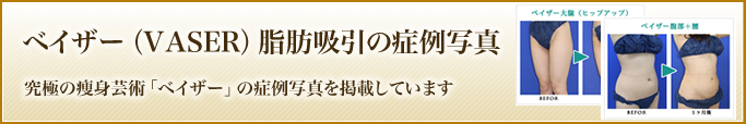 ベイザー脂肪吸引の症例写真